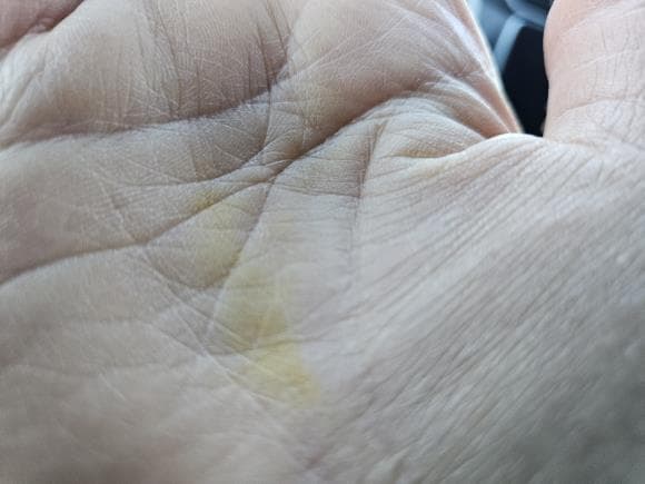 제 손바닥 뭐가 문제인지 좀 봐 주세요.