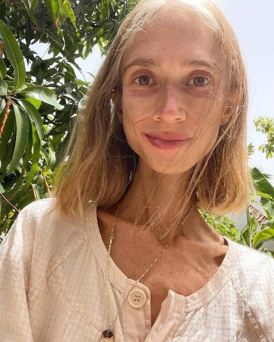 “생과일만 먹던 여성, 결국 영양실조로 사망”