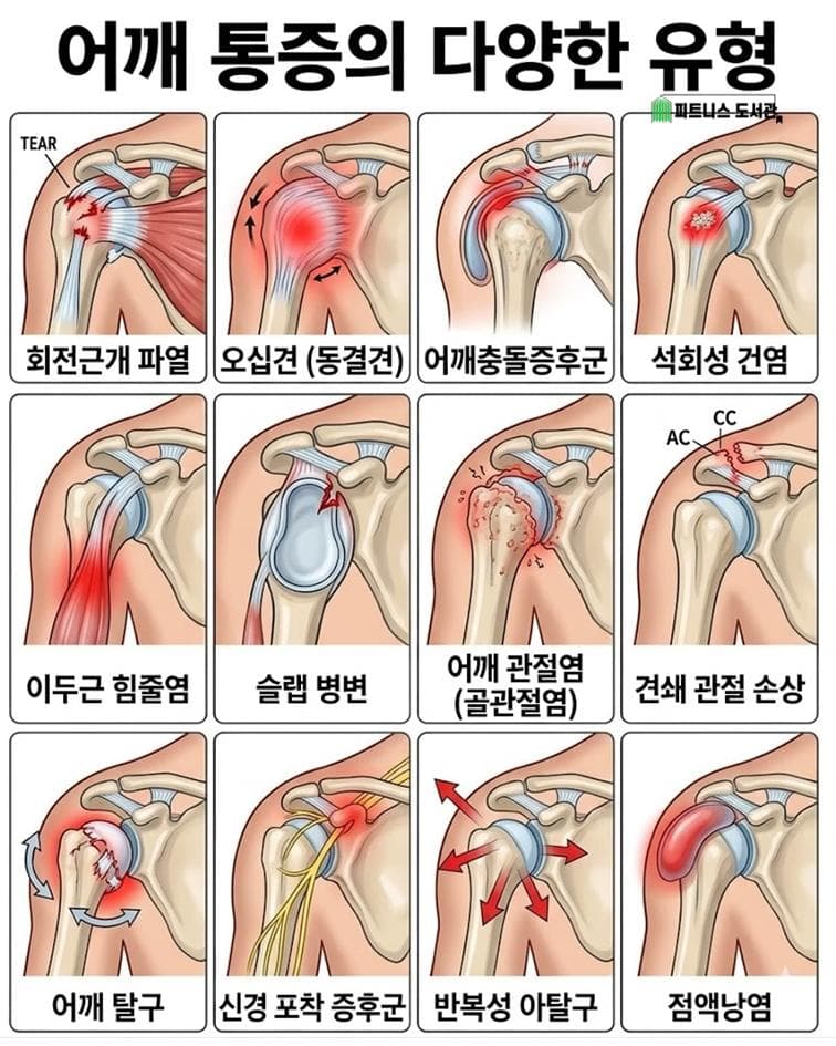 어깨 통증 유형 총정리